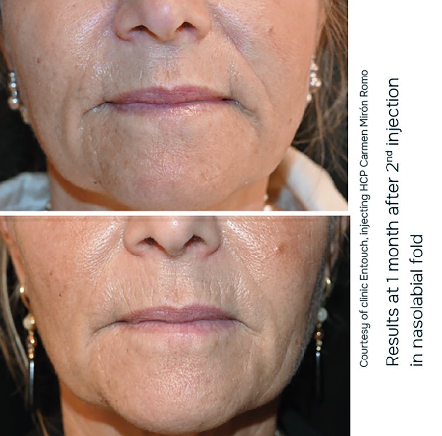 julaine-nasolabial-folds-before--and-after-results(1) julaine before and after results