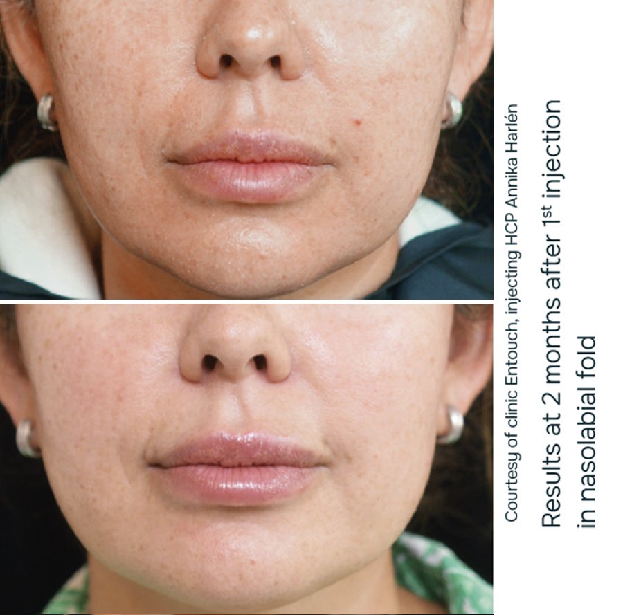 julaine-nasolabial-folds-before--and-after-results(2) julaine before and after results