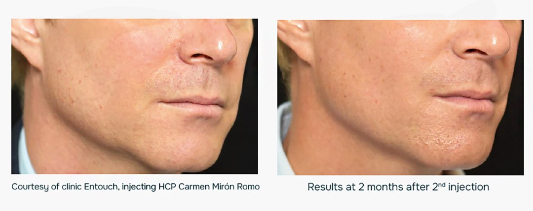 julaine-nasolabial-folds-treatment-for-men julaine nasolabial folds treatment for men