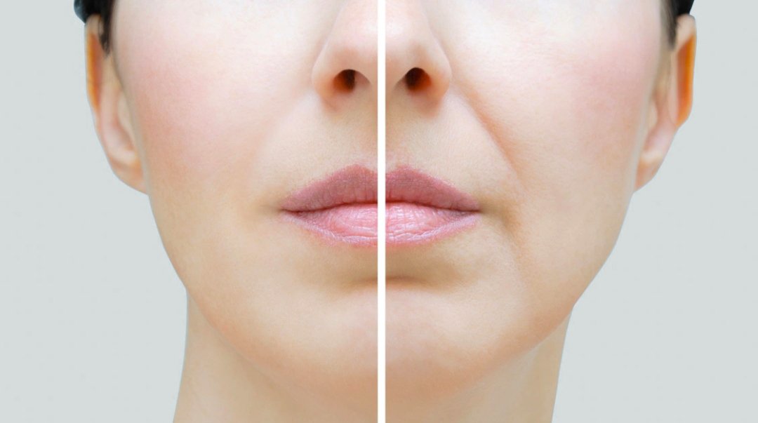 nasolabial-folds-treatment nasolabial folds