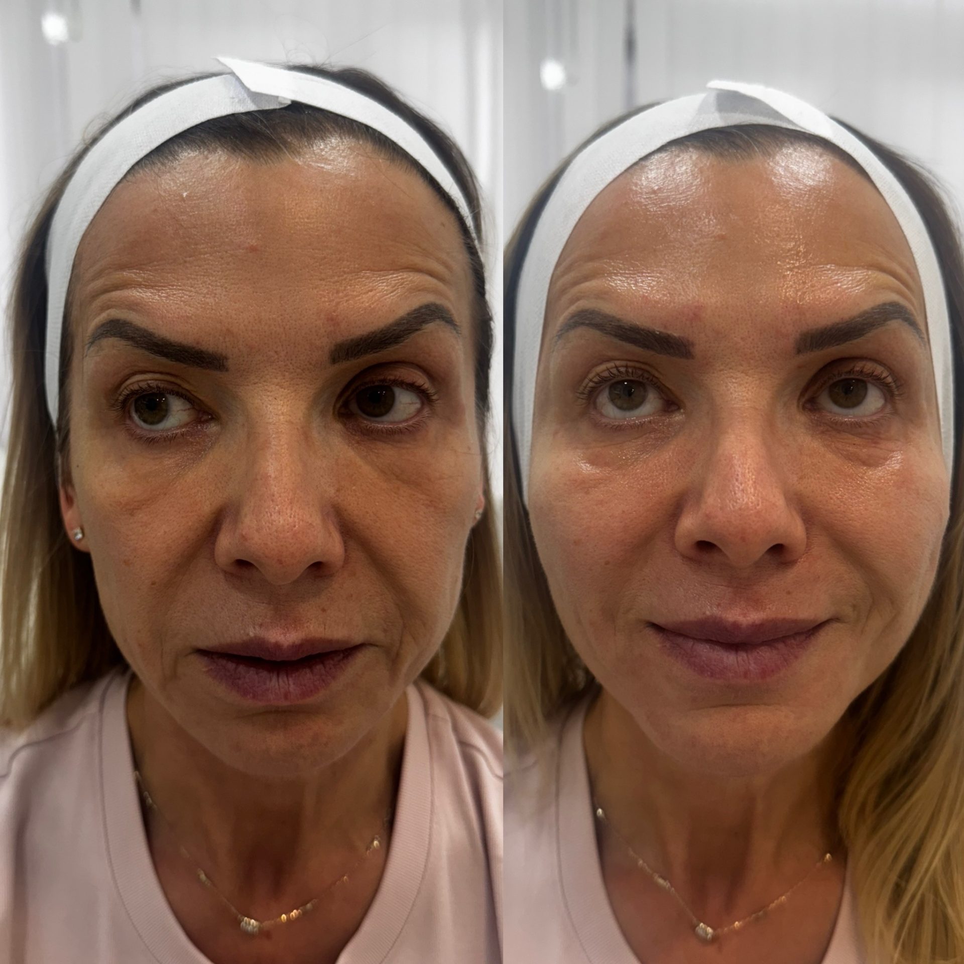 Lanluma before and after