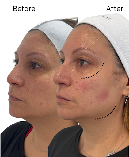 before-after1 ozempic face