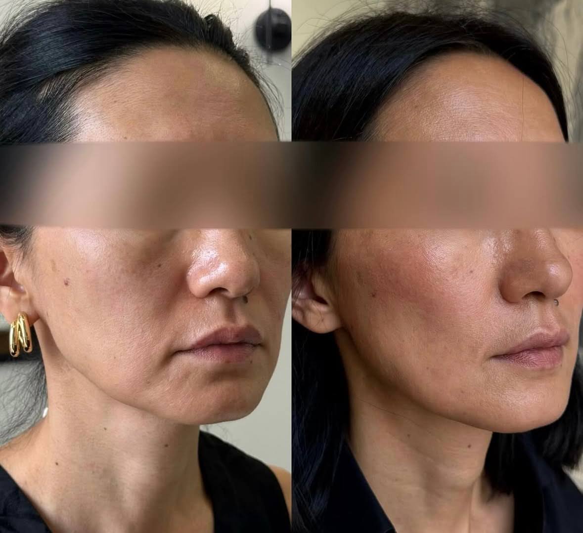 Screenshot ozempic face