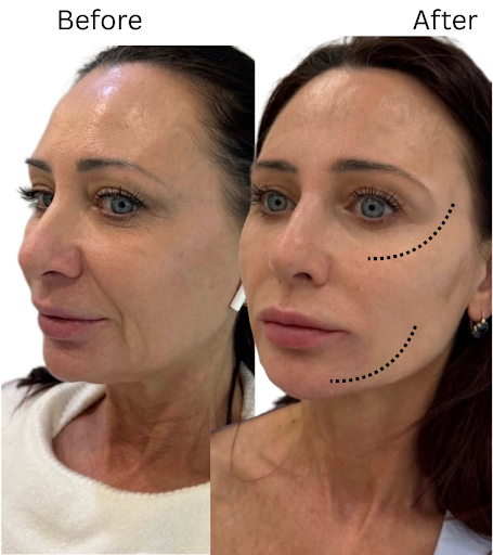 unnamed (9) ozempic face