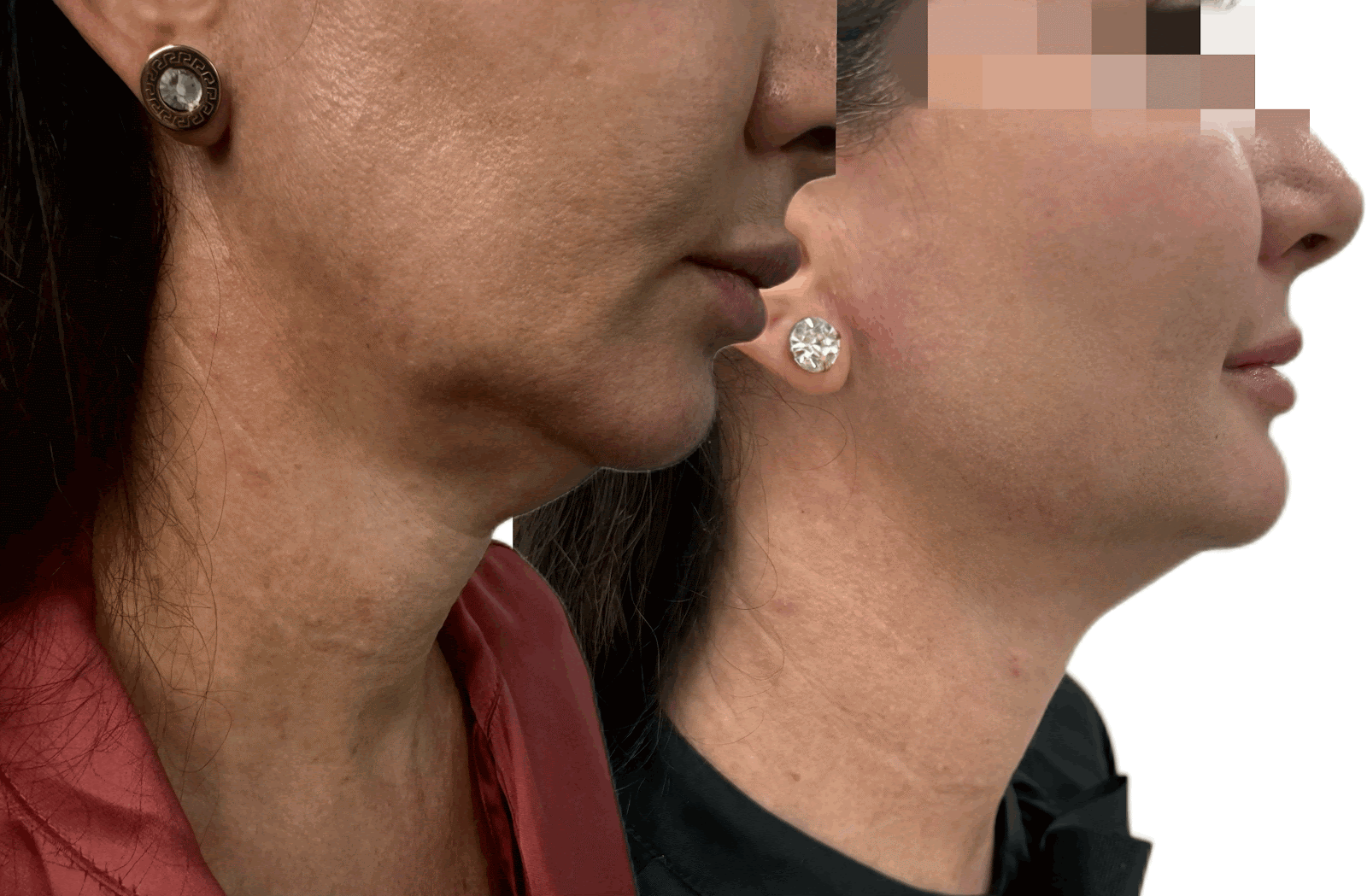 unnamed ozempic face