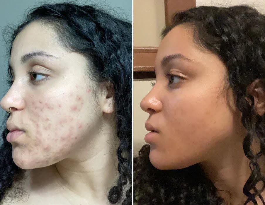 ghk-cu acne before and after GHK-CU Before and After Pictures main image 1