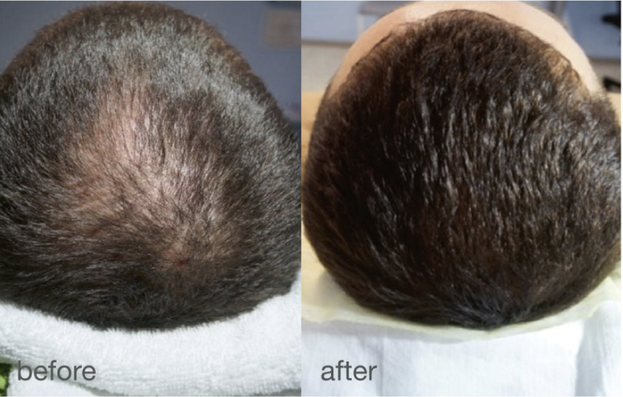 hair loss