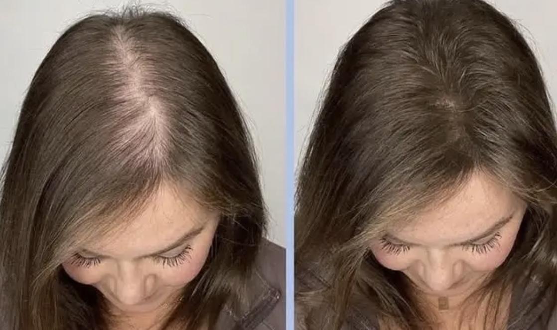 hair loss