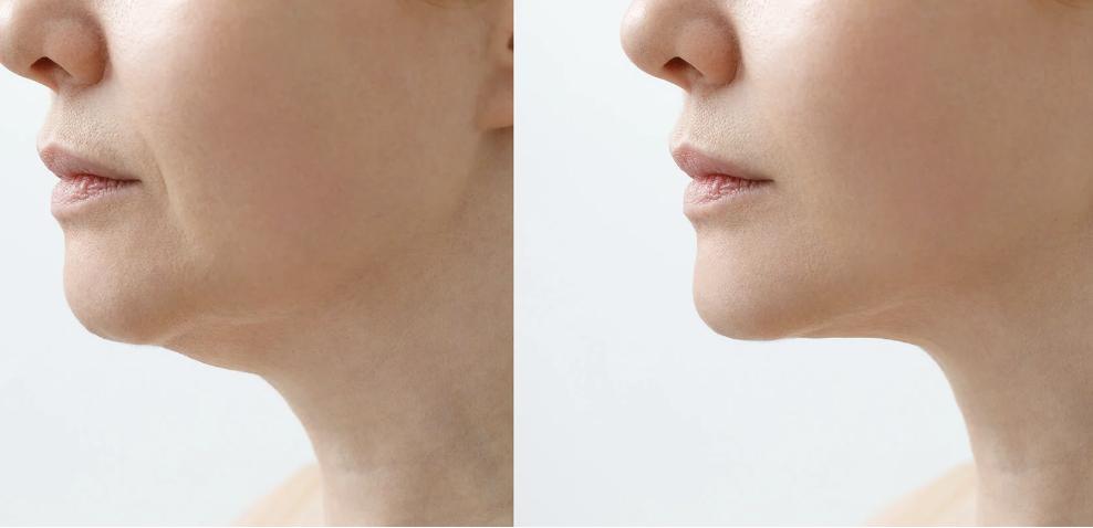 Fotona fotona 4d laser hair growth