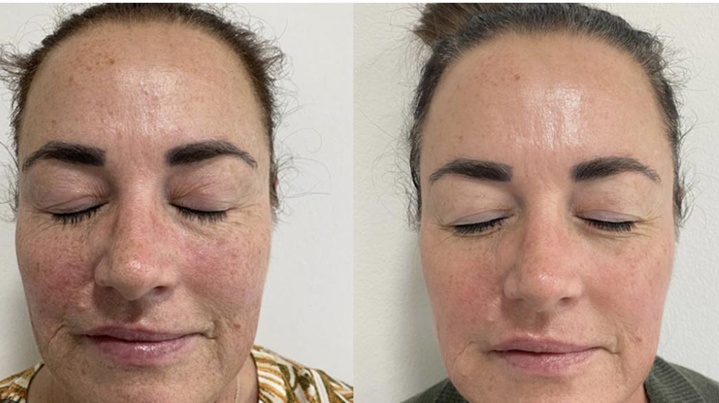 Fotona fotona 4d laser hair growth
