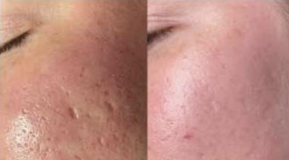 Fotona fotona 4d laser hair growth