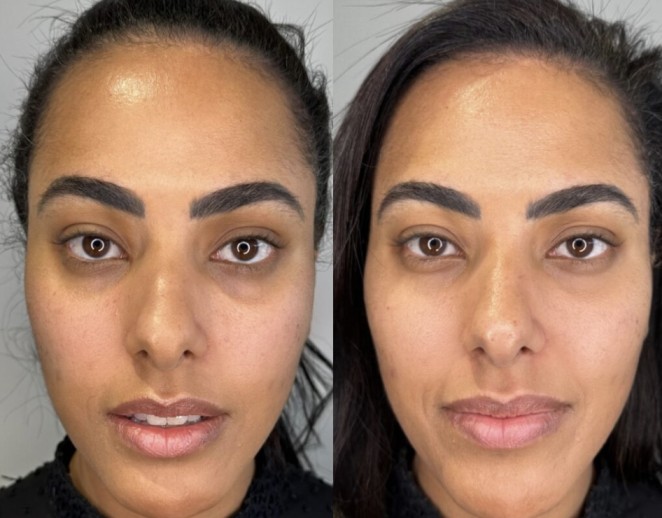 bio filler plasma