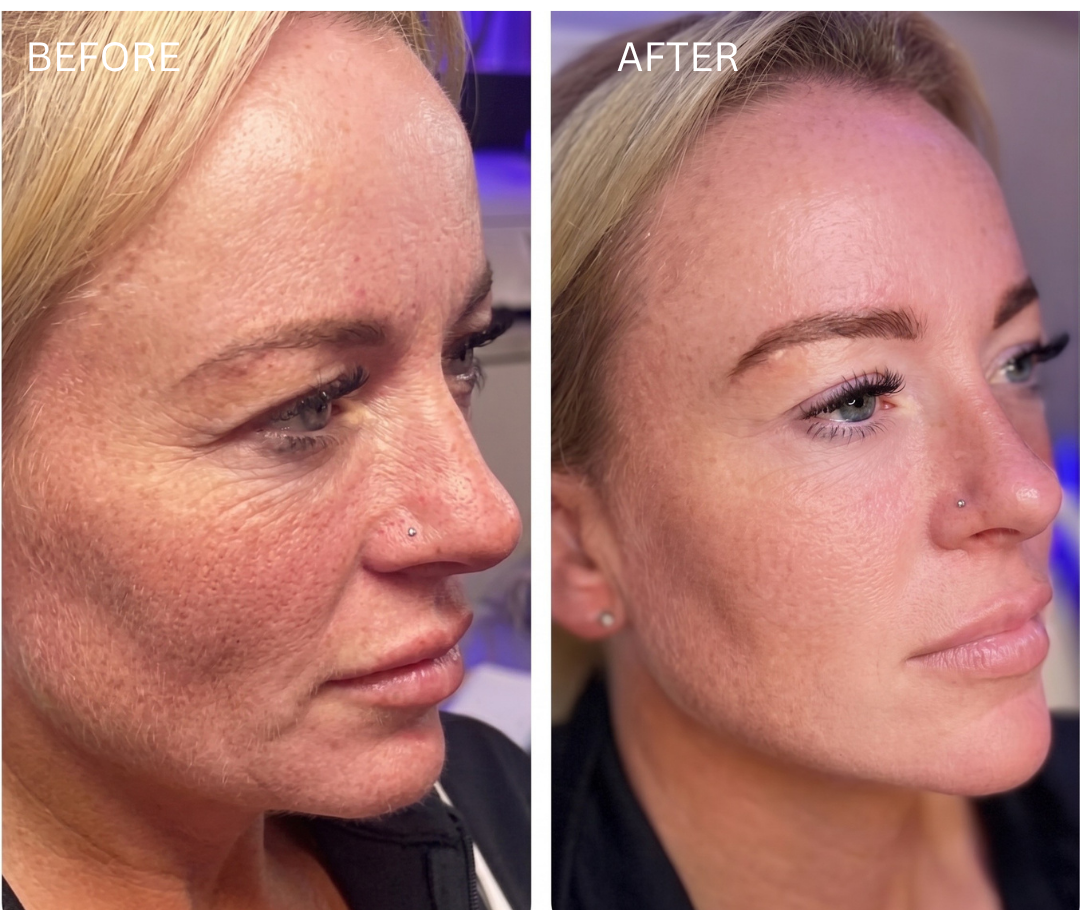 Collagen Biostimulators cellular matrix prp