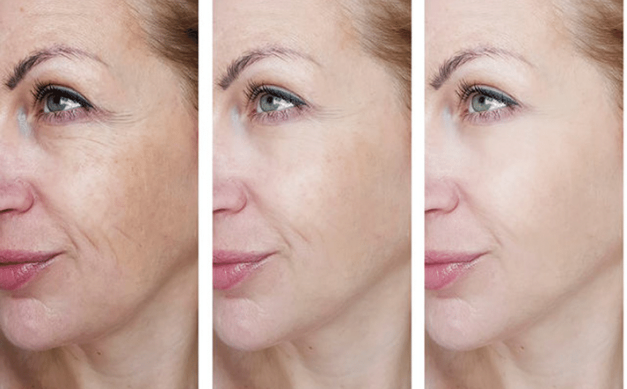 Collagen Biostimulators