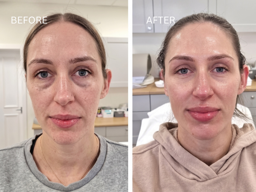 Collagen Biostimulators exosomes facial rejuvenation