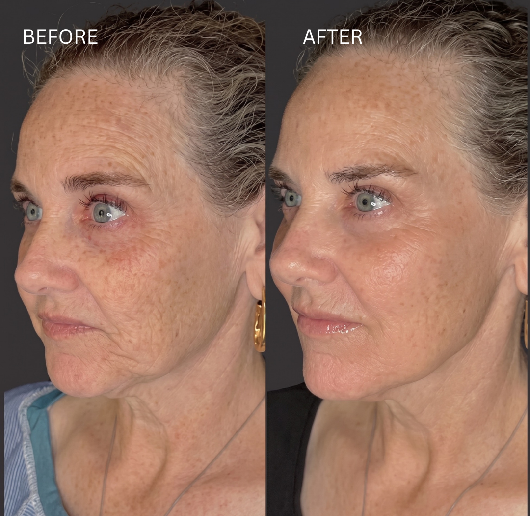 Collagen Biostimulators